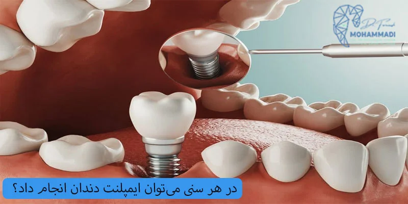 آیا در هر سنی می توان ایمپلنت دندان انجام داد؟