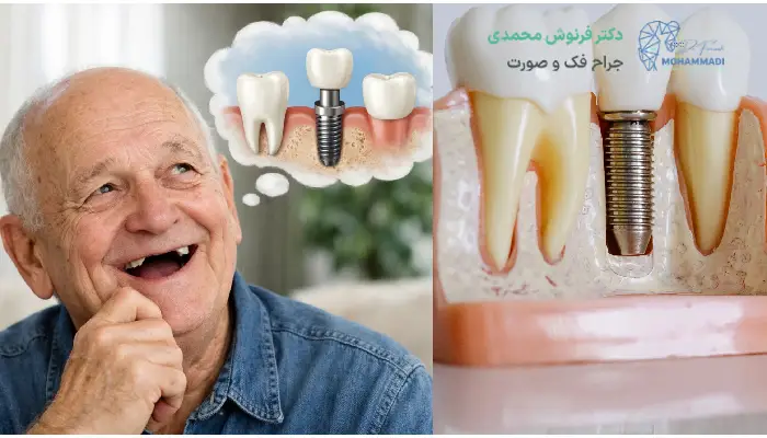 افراد کاندید ایمپلنت