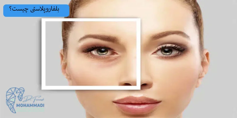 بلفاروپلاستی-چیست؟