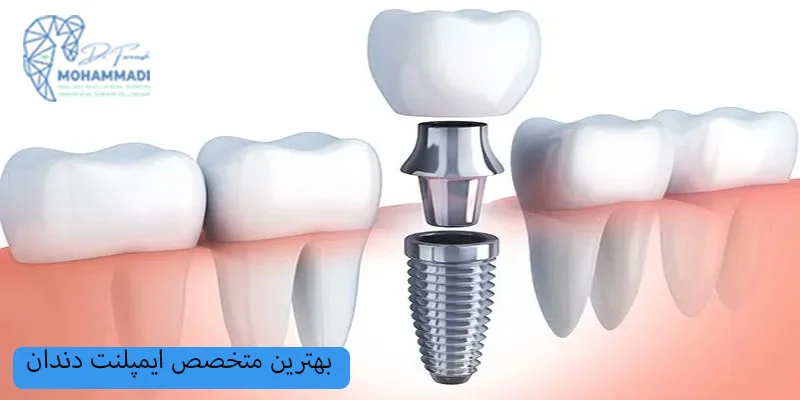 بهترین-متخصص-ایمپلنت-دندان