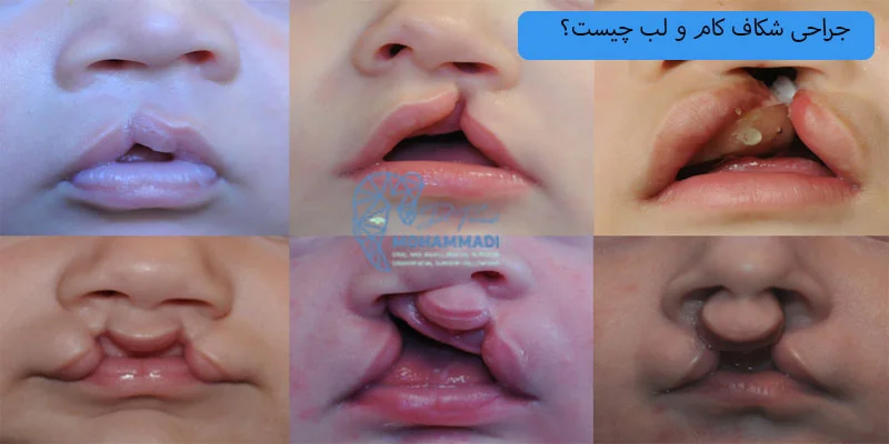 جراحی شکاف کام و لب چیست؟