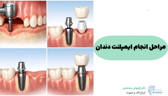 مراحل انجام ایمپلنت دندان