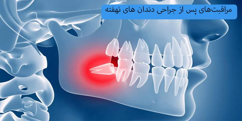 مراقبت_های-پس-از-جراحی-دندان-های-نهفته