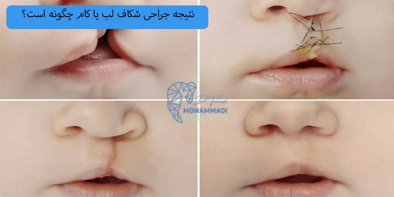 نتیجه جراحی شکاف لب یا کام چگونه است؟