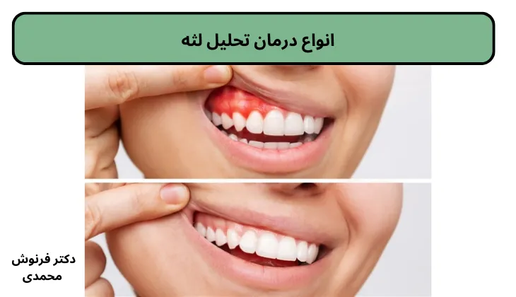 انواع درمان تحلیل لثه