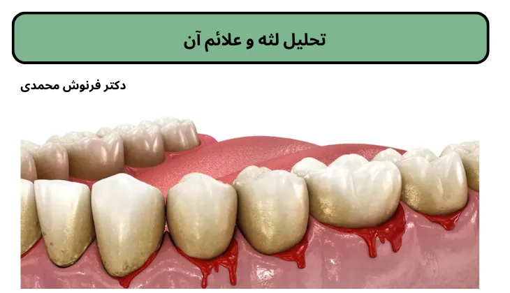 تحلیل لثه