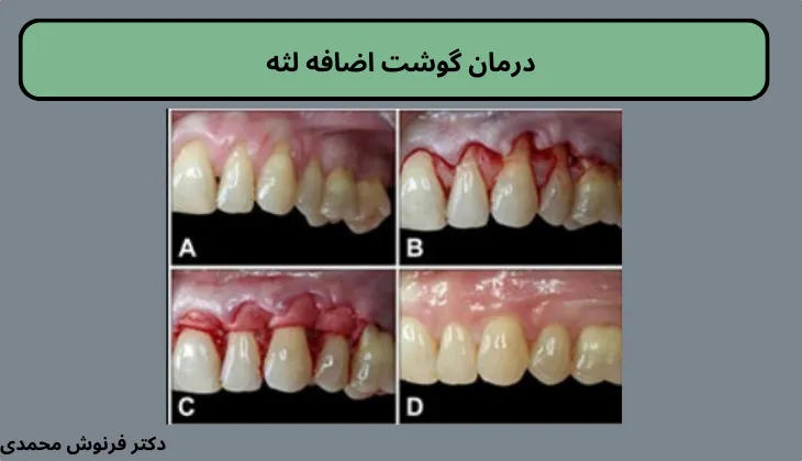 درمان گوشت اضافه لثه