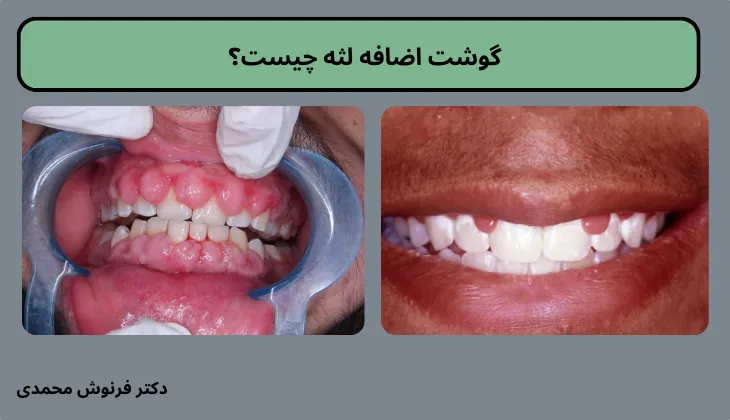 گوشت اضافه لثه