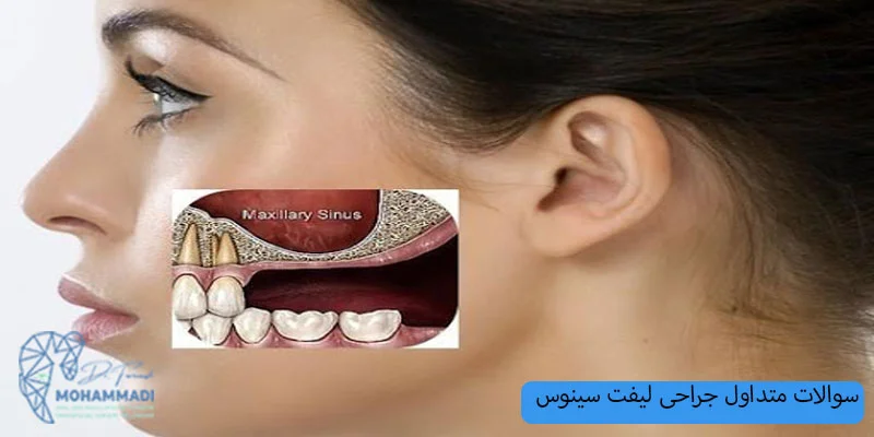 سوالات-متداول-جراحی-لیفت-سینوس