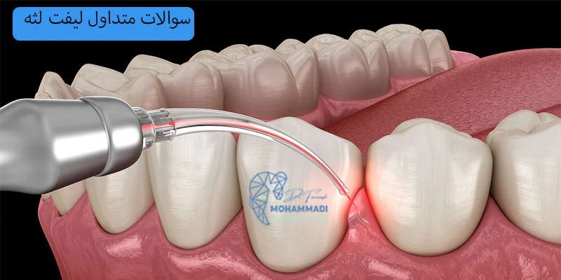سوالات-متداول-لیفت-لثه