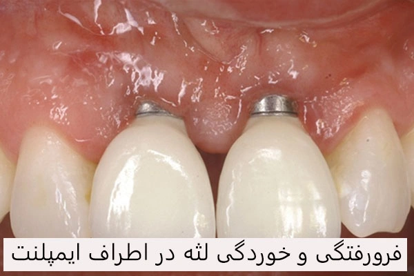 آسیب به لثه در اثر پس زدن ایمپلنت