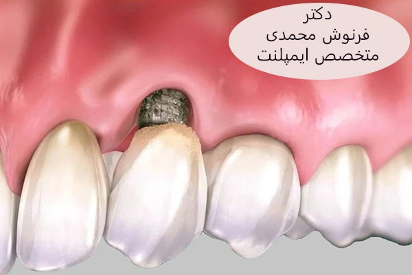 پس زدن ایمپلنت دندان