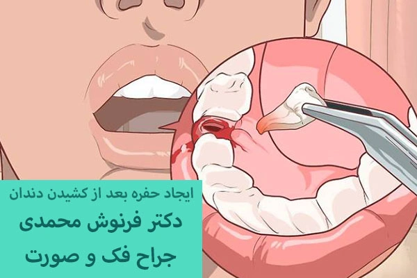 ایجاد حفره خشک بعد از کشیدن دندان