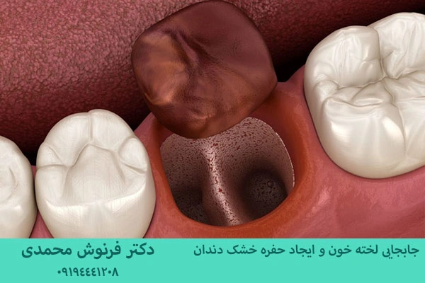 حفره خشک دندان
