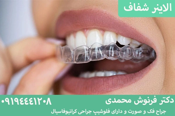 ارتودنسی نامرئی؛ الاینر شفاف
