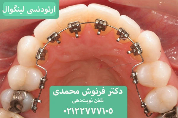 براکت پشت دندان؛ ارتودنسی نامرئی
