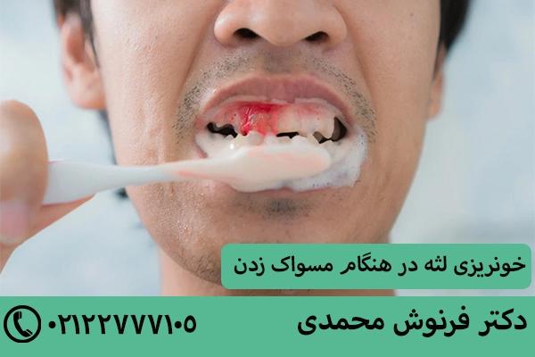 خونریزی لثه