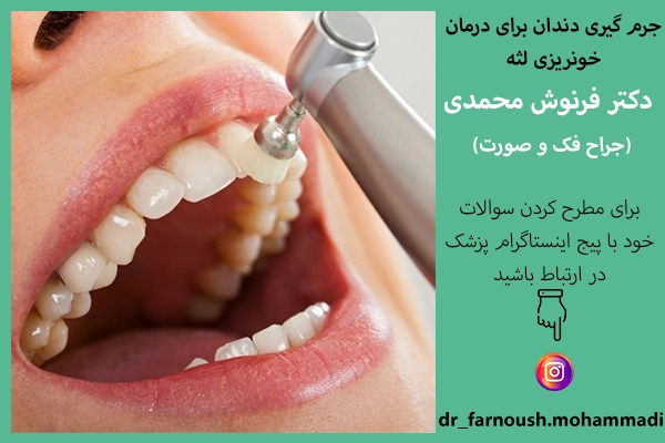 جرم گیری دندان برای درمان خونریزی لثه