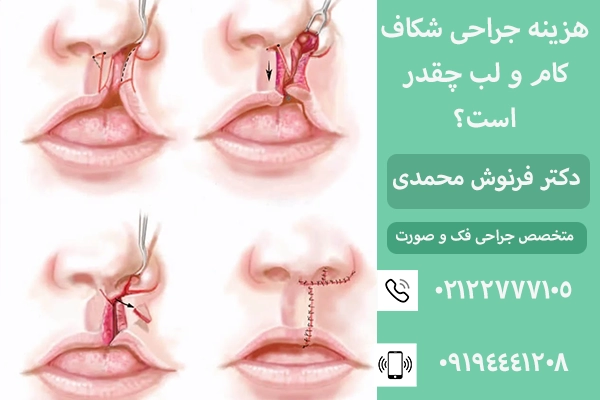هزینه جراحی شکاف لب و کام