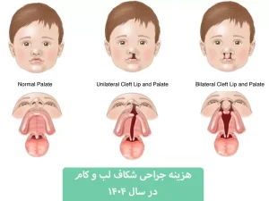 هزینه جراحی شکاف کام و لب