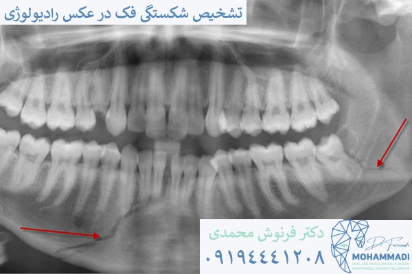 رادیولوژی شکستگی فک