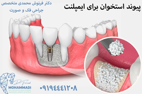 پیوند استخوان فک برای ایمپلت