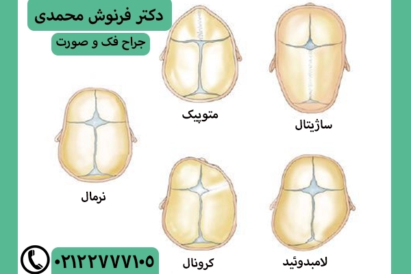 بدشکلی جمجمه نوزادان