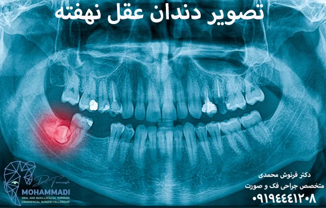 جراحی دندان عقل