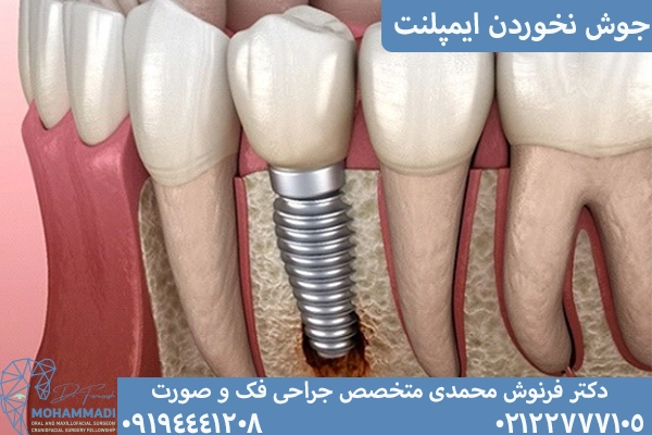 جوش نخوردن ایمپلنت