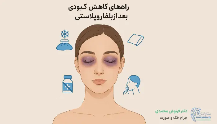 راه های کاهش کبودی بعد از بلفاروپلاستی