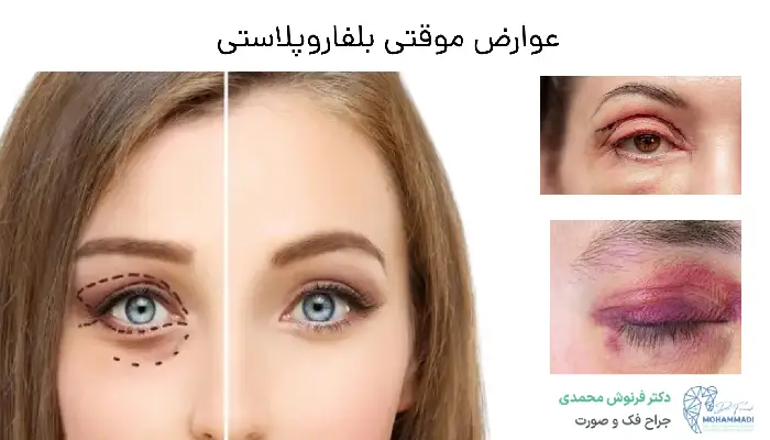 عوارض موقتی بلفاروپلاستی
