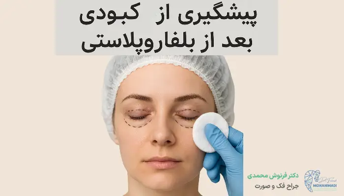 پیشگیری از کبودی بعد از بلفاروپلاستی