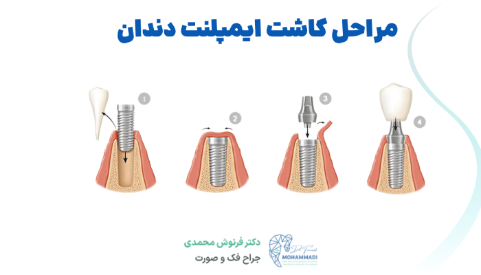 7 مرحله ی ایمپلنت دندان