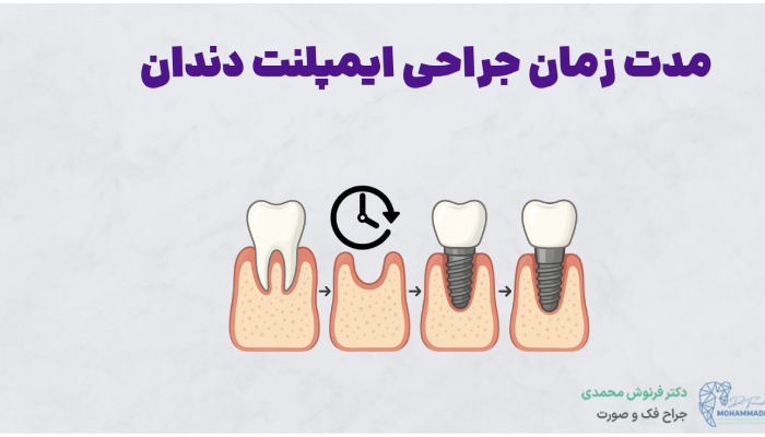 مدت زمان جراحی ایمپلنت دندان
