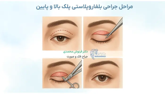 مراحل جراحی بلفاروپلاستی پلک بالا و پایین