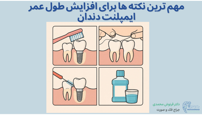 مهم ترین نکته ها برای افزایش طول عمر ایمپلنت دندان