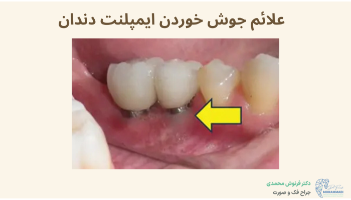 علائم جوش خوردن ایمپلنت دندان