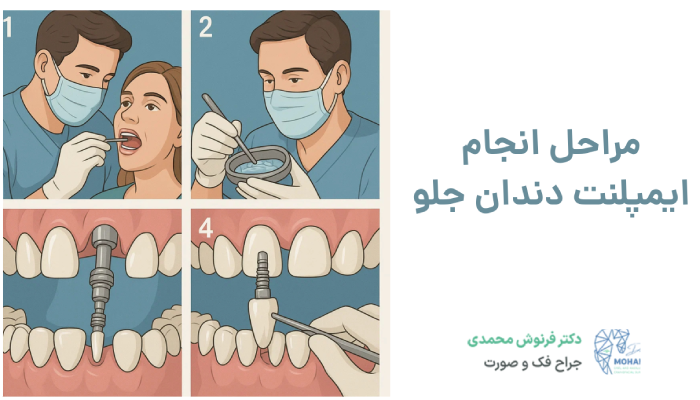 مراحل انجام ایمپلنت دندان جلو