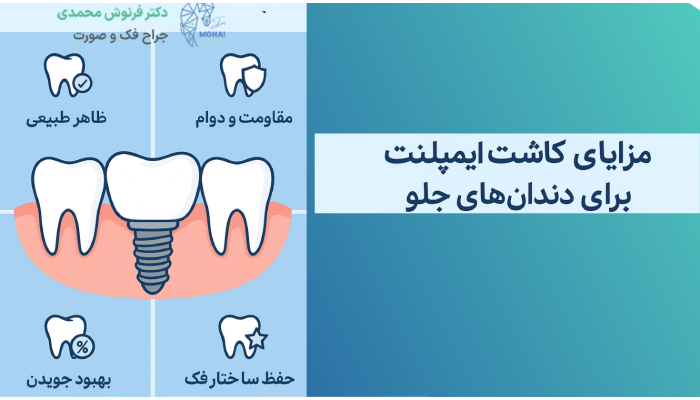 مزایای کاشت ایمپلنت دندان جلو