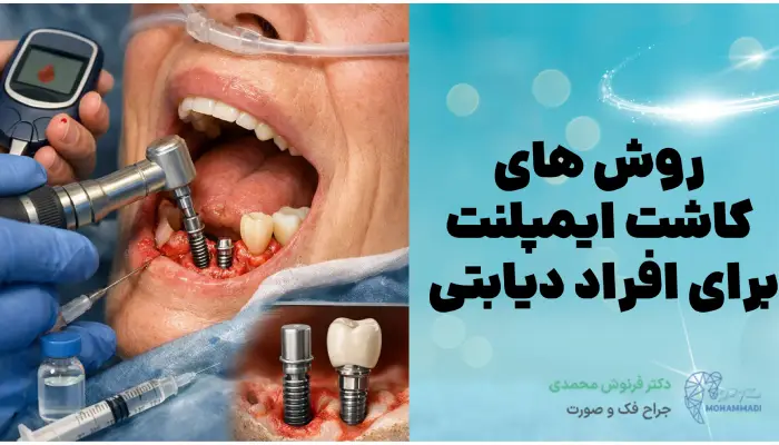 روش های
کاشت ایمپلنت
برای افراد دیابتی