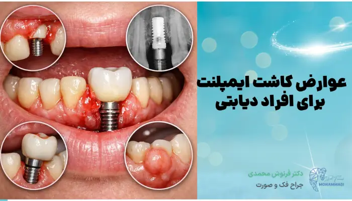 عوارض ایمپلنت در افراد دیابتی